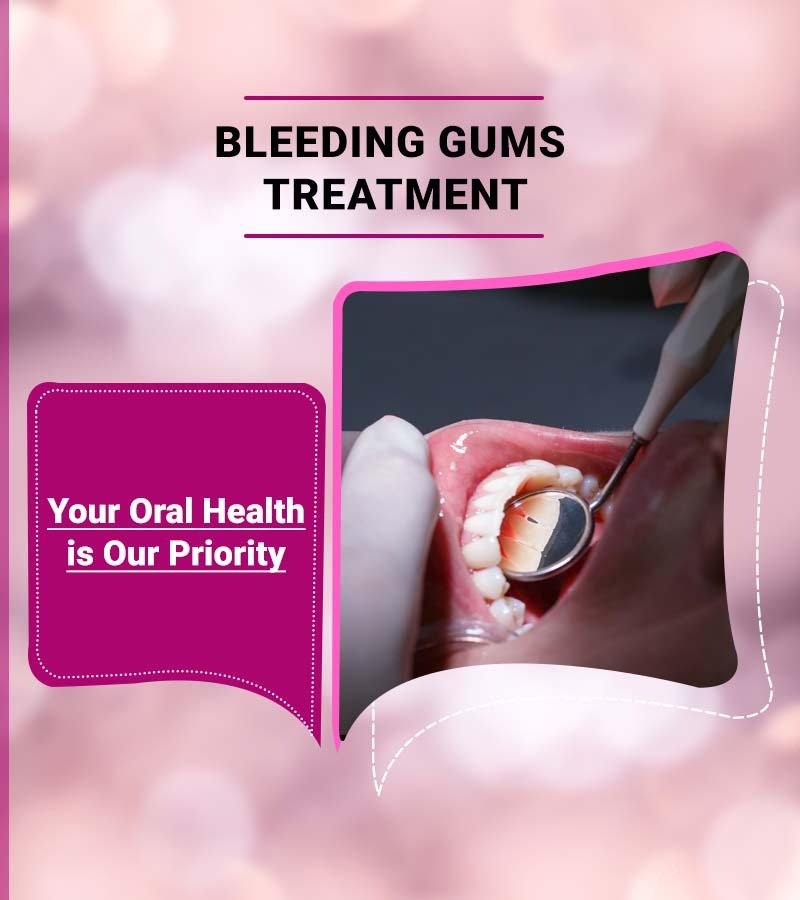 Bleeding Gums