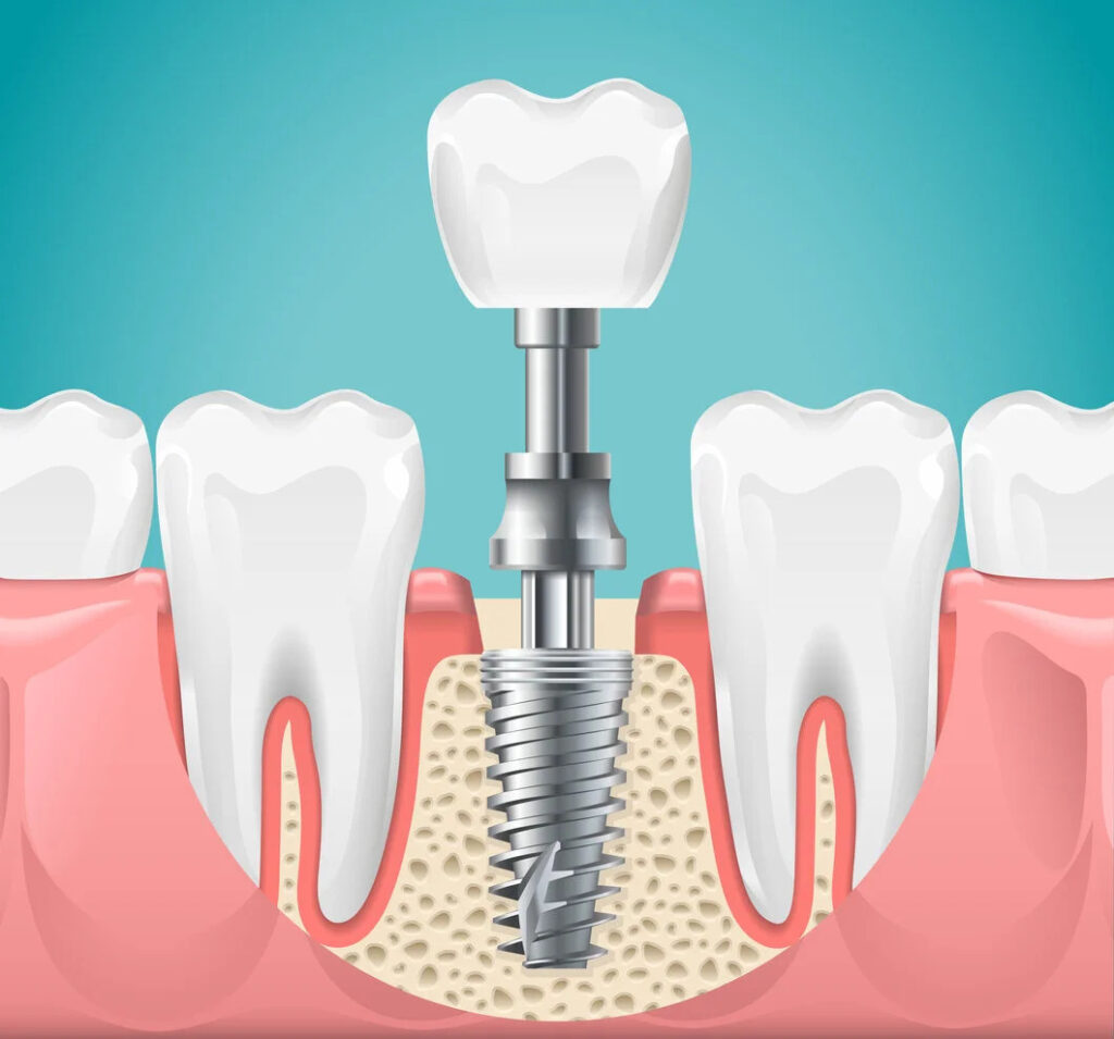 Dental Implant