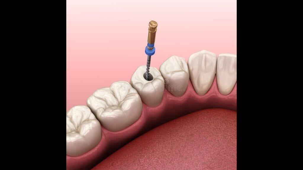 Root canal treatment in Kolkata