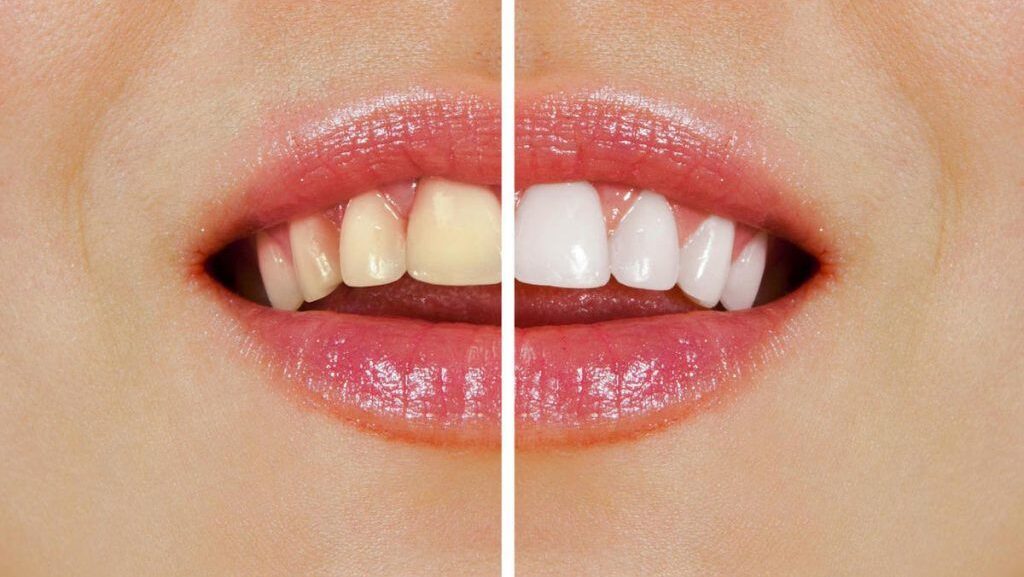 Teeth whitening treatment in Dum Dum
