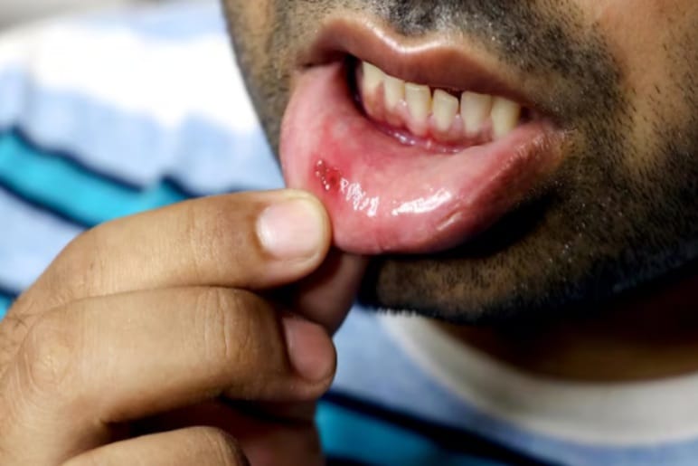 What Are Mouth Ulcers?