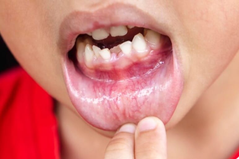 Why Do Mouth Ulcers Occur?