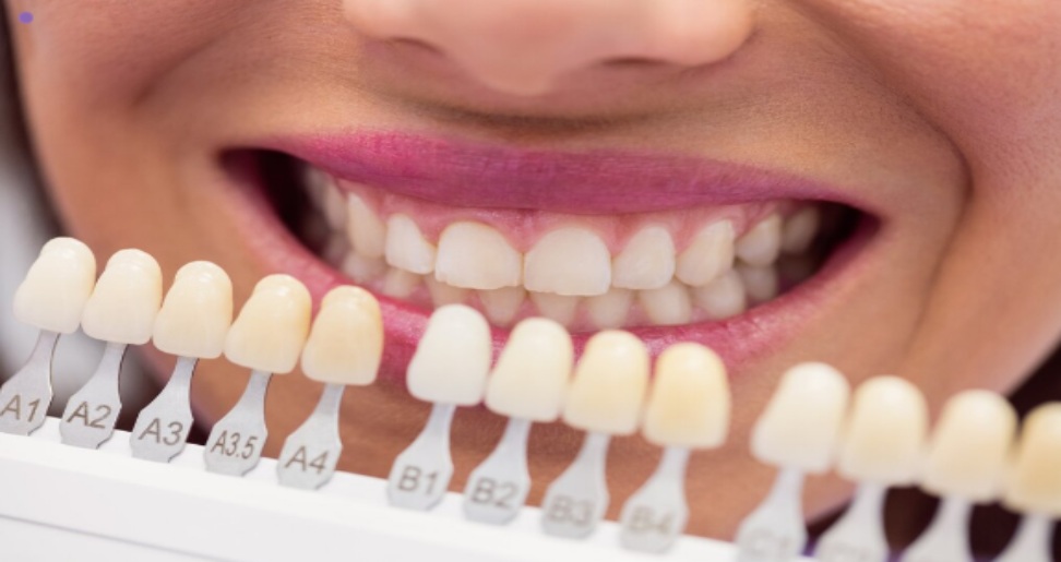 Veneers vs. Crowns: What Are the Pros and Cons of Each?