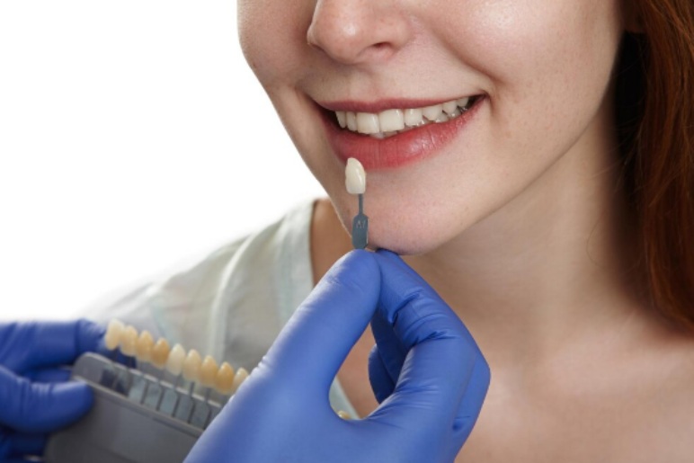 Pros and Cons of Veneers