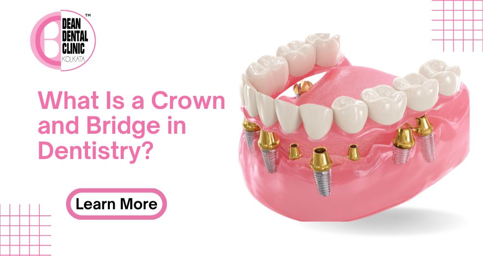 What Is a Crown and Bridge in Dentistry?| Dean Dental Clinic